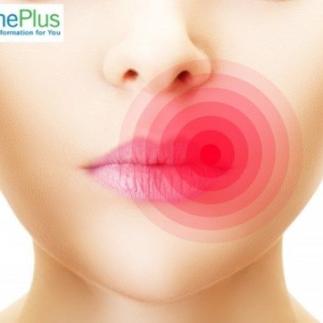 Έρπης στο στόμα: Αίτια και πρώιμα συμπτώματα