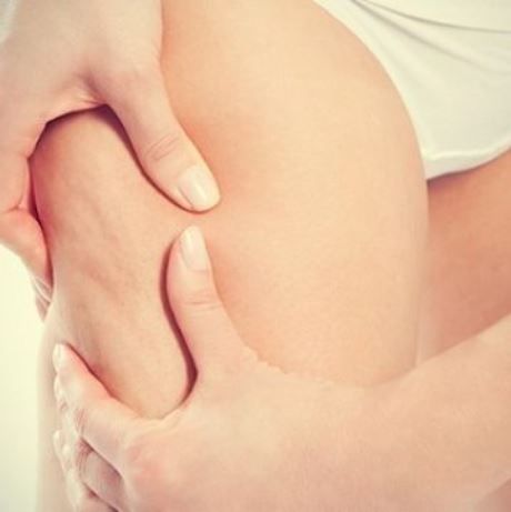 Κυτταρίτιδα κι εγκυμοσύνη: Όλα όσα πρέπει να γνωρίζεις για να την αντιμετωπίσεις