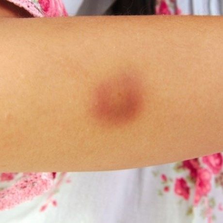 Πώς θα φύγει πιο γρήγορα η μελανιά