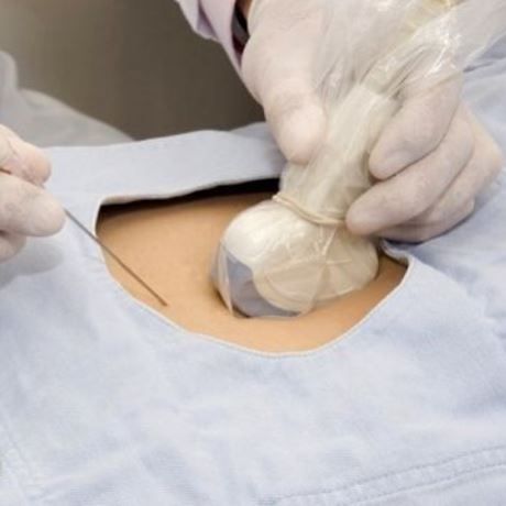 Αμνιοπαρακέντηση: Γιατί δεν πρέπει να φοβάστε