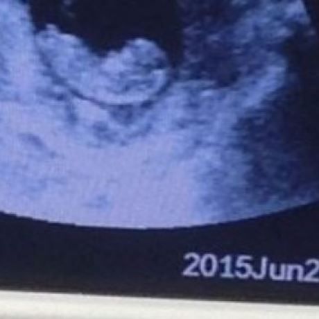 Ανατριχιαστική εικόνα: «Δαίμονας» σε υπέρηχο εμβρύου