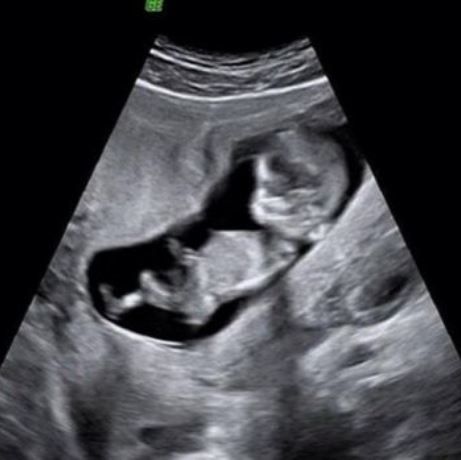 Πασίγνωστη Ελληνίδα ηθοποιός περιμένει το δεύτερο παιδί της & δείχνει το υπερηχογράφημα