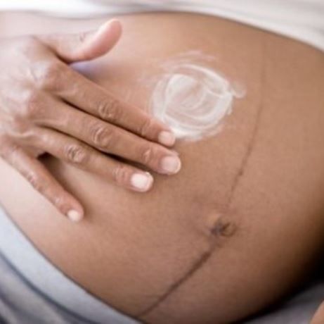 Πώς θα αποφύγετε τις ραγάδες στην εγκυμοσύνη!