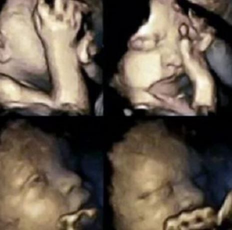 Συγκλονιστικό: Δείτε πώς αντιδρά το έμβρυο στο τσιγάρο κατά τη διάρκεια της εγκυμοσύνης