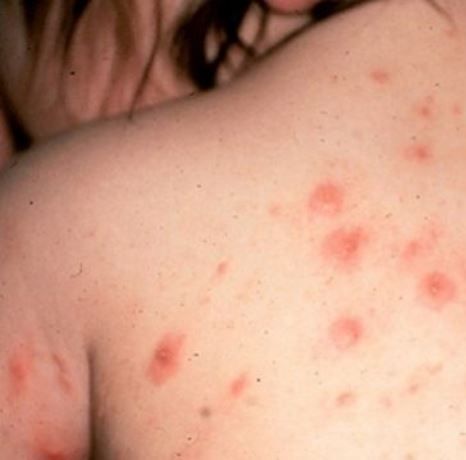 Προσοχή: Κρούσματα ψώρας σε βρεφονηπιακό σταθμό