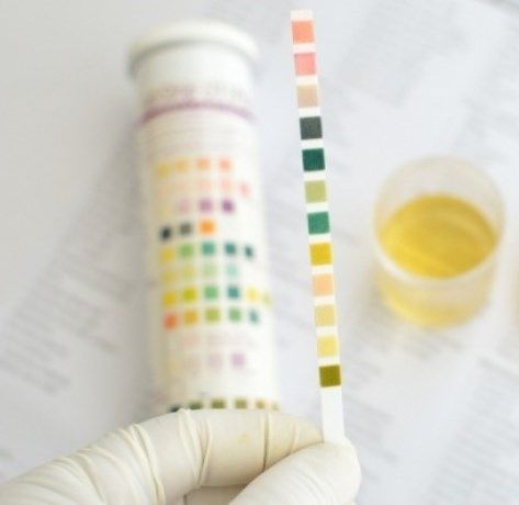 Θολά ούρα: Τι δείχνουν για την υγεία σας