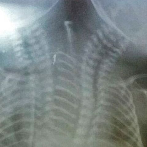 Μωρό με 2 κεφάλια γεννήθηκε στην Ινδία (φωτογραφίες)