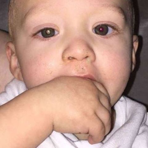 Μπορείτε να διακρίνετε τον καρκίνο στο μάτι αυτού του παιδιού;