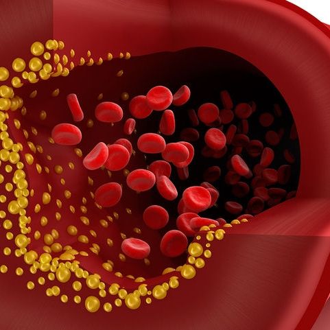 Αθηροσκλήρωση: Με ποια διατροφή θα προστατεύσετε τα αγγεία σας