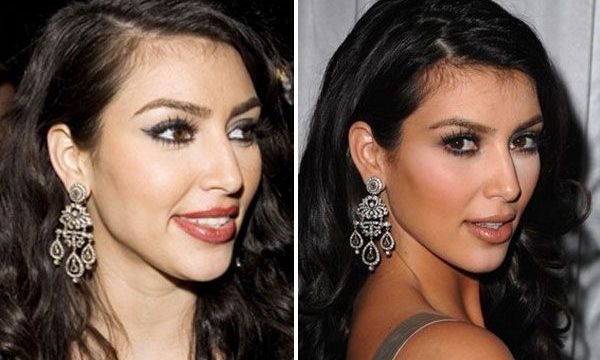 Οι πλαστικές επεμβάσεις της Kim Kardashian