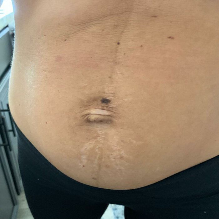 Δεν φαντάζεσαι πώς είναι η κοιλιά της διάσημης γυμνάστριας μετά την τρίτη γέννα