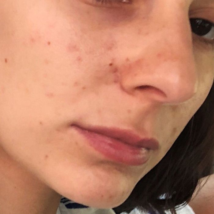 Στην συνέντευξή της τόνισε: «Έγινα ειδική στο να καλύπτω την ακμή μου. Έσπαγα τα σπυράκια μου, καθάριζα πολύ καλά το πρόσωπό μου και έβαζα κρέμες ειδικές για την ακμή, τα κάλυπτα με λίγο concealer και έτσι ξεκινούσε η ρουτίνα του μακιγιάζ μου».