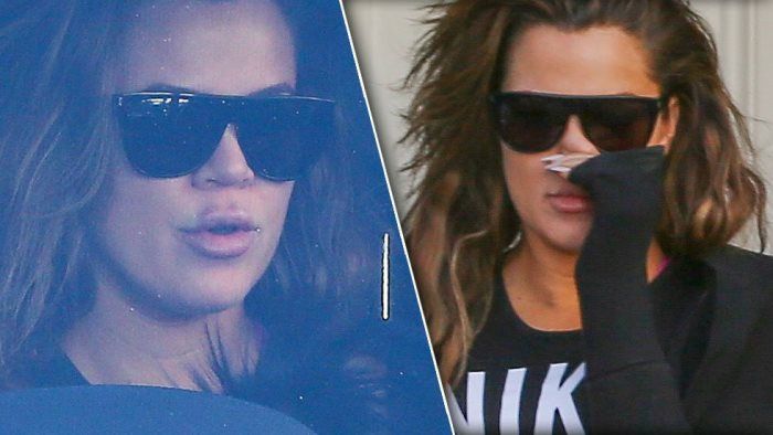 khloe-kardashian-lip-injections1 6ea99