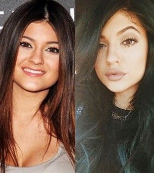 kylie-jenner-before-and-after fad23
