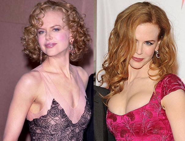 Nicole Kidman Before and After Plastic Surgery Pictures 4 65d1a