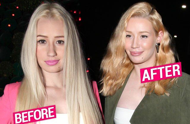 iggy azalea plastic surgery face before after photos 6c666