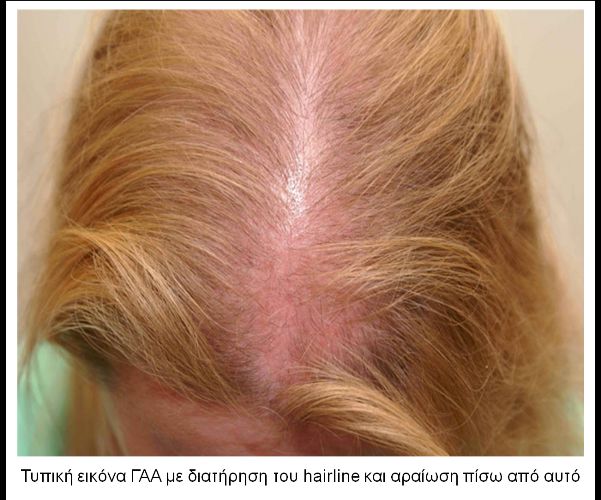 gaa hairline 9e215