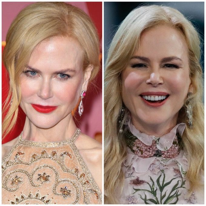 nicole kidman plastic surgery