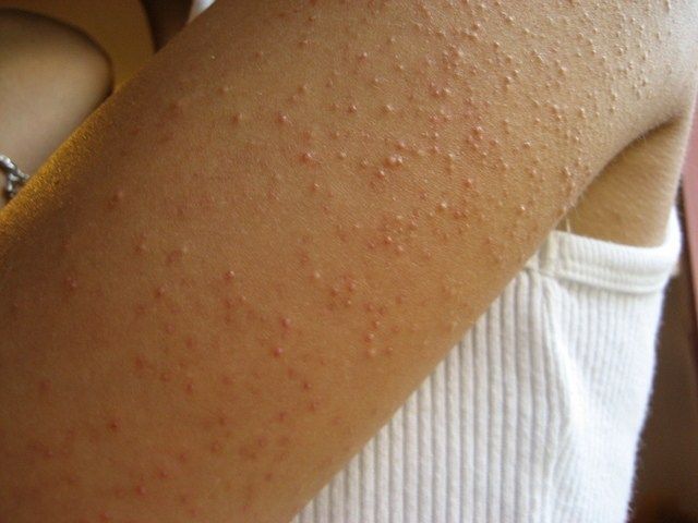 What is keratosis pilaris