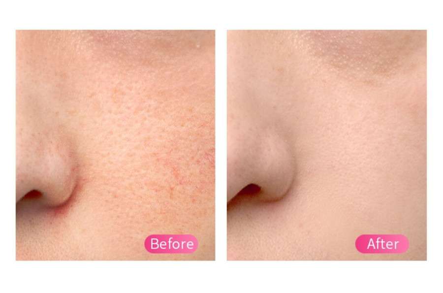 FOREO Cryo Therapy Before After pic